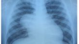 EXCL: Doctors find rare tumor in 23-year-old vaper's lung