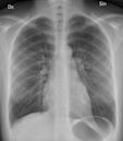 Chest radiograph