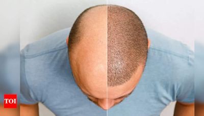 Does age matter for hair re-growth post hair transplant? | - Times of India