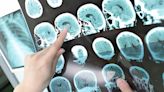 Un grupo de científicos españoles logra predecir con IA la evolución que tendrán los pacientes con esclerosis múltiple