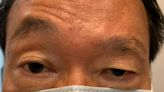 臉部受傷竟變「大小眼」困擾10年！醫生一招治好 有效改善眼瞼下垂