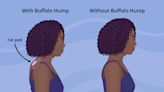 Can You Get Rid of a Buffalo Hump?