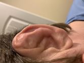 Cauliflower ear