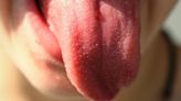 27歲女「舌頭反覆破洞」拖4年 竟罹患口腔癌手術切一半