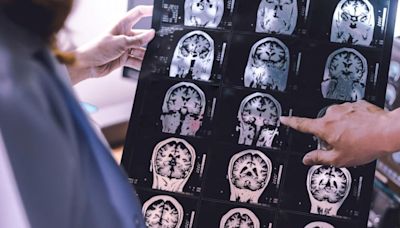 Children with autism have more gray matter in brain's outer layer than others