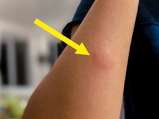 Experts Are Sharing The One Crucial Mistake You Should Absolutely Avoid With Mosquito Bites