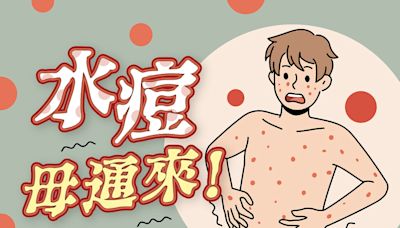 水痘毋通來！台東縣衛生局籲留意幼童衛生降低感染風險