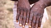 UN Health Agency Declares Monkeypox A Global Emergency