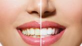9 Shades Lighter in 1 Week! This LED Teeth Whitening Kit Is 52% Off
