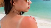 Signs and Symptoms of Sun Poisoning