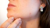 Women with acne face social stigma