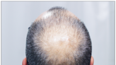 Oral Drug as Effective as Topical Cream for Male Pattern Baldness