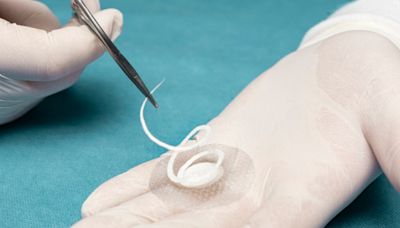 Kerecis unveils Shield Spiral device for advanced wound care