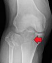 Tibial plateau fracture