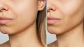 The Truth About How Buccal Fat Removal Really Works