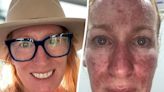 Mother left ‘looking like Freddy Krueger’ reveals first skin cancer warning sign