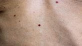 Should Red Moles (Cherry Angiomas) Be Removed?