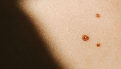 Is that mole melanoma? How to tell if a mole is cancerous or not