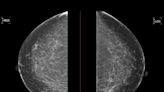 A woman's breast cancer was missed on multiple mammograms. She had higher breast density, which can hide tumors.