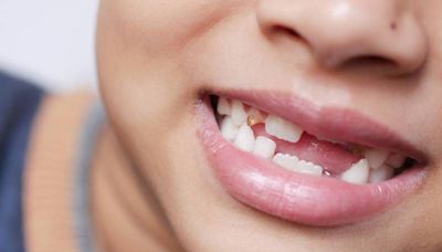 健康網》你剩幾顆牙？ 牙醫：缺牙不補恐釀7後果 - 自由健康網