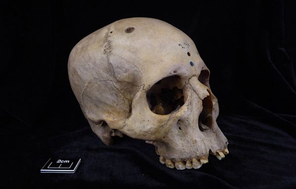 Ancient Egyptian skull shows oldest attempt at cancer surgery