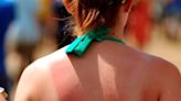 Nearly one in two Irish people say sunburn is worth it to get a tan – despite high awareness of skin cancer