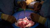 Pig hearts sewn into brain-dead people furthers research for saving humans with animal organs