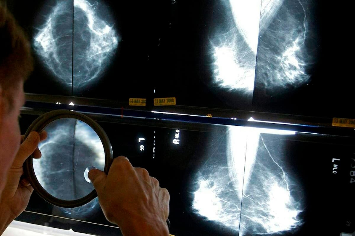 40 the new target age for breast cancer screening: Canadian Cancer Society