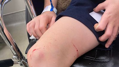A boy needed stitches after swimming in a man-made lake in Montreal. Did a fish attack him?