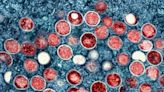 En Kenia autoridades luchan por controlar nuevo brote de viruela símica