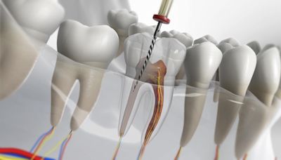 齲齒補後的困惑：為何你仍可能需要杜牙根治療？ | am730
