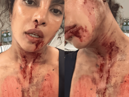 "Its really glamorous": Priyanka Chopra shares gory picture of bloodied face; reveals getting injured on The Bluff sets