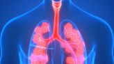 NCH Health: New procedure allows COPD patients to breath easier