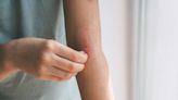 Arcutis bags FDA approval for atopic dermatitis cream after delay