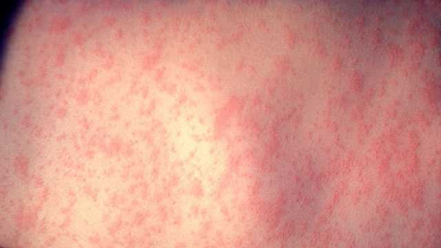 West Virginia confirms first measles case since 2009