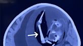 Fetus of twin is surgically removed from the SKULL of sister in China