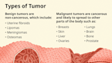 Tumor Defined: The Different Types and How They Form