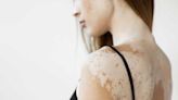 Vitiligo : le premier traitement contre cette maladie de la peau disponible en pharmacie