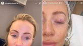 Loose Women’s Olivia Attwood forced to pull out of Christmas party due to injury