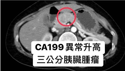 40歲女不菸不酒、無不良嗜好！照斷層驚見胰臟腫瘤 院長示警：7類高風險族群快篩檢