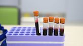 Blood Tests for Wegovy? Diagnostic Companies Target GLP-1s