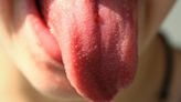 舌苔發白不可掉以輕心 NHS報導：可能是「這5大疾病」在作怪
