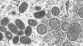 CDC, Florida health officials investigating state’s first presumptive monkeypox case