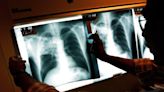 Why tuberculosis cases have risen in recent years after decades of decline