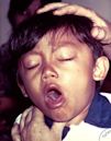 Whooping cough