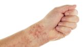 Can a Skin Blanching Test Tell You if a Rash is Serious? Experts Explain