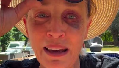 Sharon Stone Shows Off Shiner To Reassure Concerned Fans: 'I Know You're All Worried'