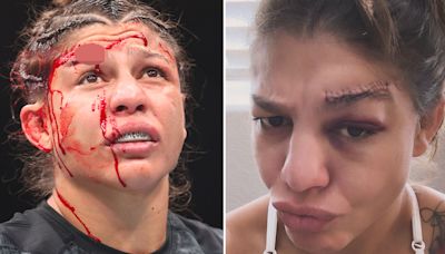 UFC star reveals gruesome scar after suffering gaping gash 'down to the bone'