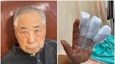 86歲氣象主播李富城才失智 「3根手指被壓扁」急開刀