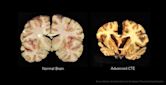 Chronic traumatic encephalopathy